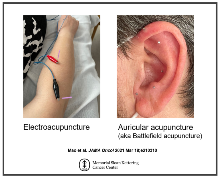 Electroacupuncture vs. Auricular acupuncture