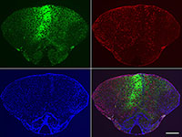 Brain of wild type zebrafish 8 months following the transplantation of tsc2 homozygous mutant cells labeled with green fluorescent protein (GFP). Upper left: GFP (green); upper right: phospho-S6, a marker of mTORC1 signaling (red); lower left: DAPI to identify cell nuclei (blue); lower right: merged image. Scale bar equals 200 Î¼m. 