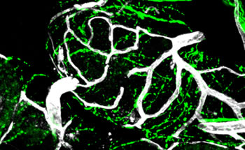 Sympathetic-nerve fibers (green) are closely intertwined with blood vessels (white). Norepinephrine released by nerve fibers stimulates vessel proliferation that fuels tumor growth.