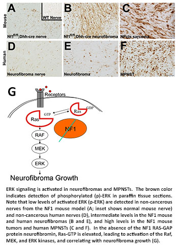 ERK signaling is activated in neurofibromas and MPNSTs.  The brown color indicates detection of phosphorylated (p)-ERK in paraffin tissue sections.  Note that low levels of activated ERK (p-ERK) are detected in non-cancerous nerves from the NF1 mouse model (A; inset shows normal mouse nerve) and non-cancerous human nerves (D), intermediate levels in the NF1 mouse and human neurofibromas (B and E), and high levels in the NF1 mouse tumors and human MPNSTs (C and F).  In the absence of the NF1 RAS-GAP protein neurofibromin, Ras-GTP is elevated, leading to activation of the Raf, MEK, and ERK kinases, and correlating with neurofibroma growth (G).